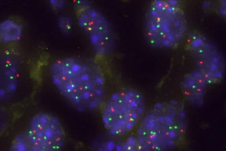 Grupo de células tumorales pulmonares. Foto: Centro de Investigación del Cáncer