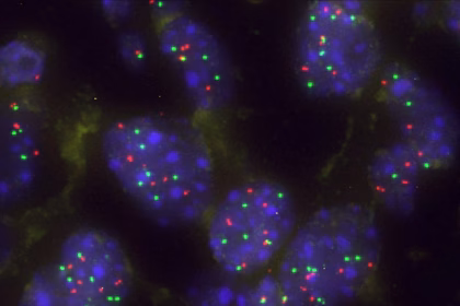 Grupo de células tumorales pulmonares. Foto: Centro de Investigación del Cáncer