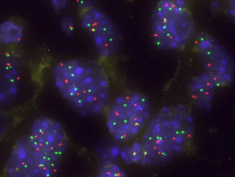 Grupo de células tumorales pulmonares. Foto: Centro de Investigación del Cáncer